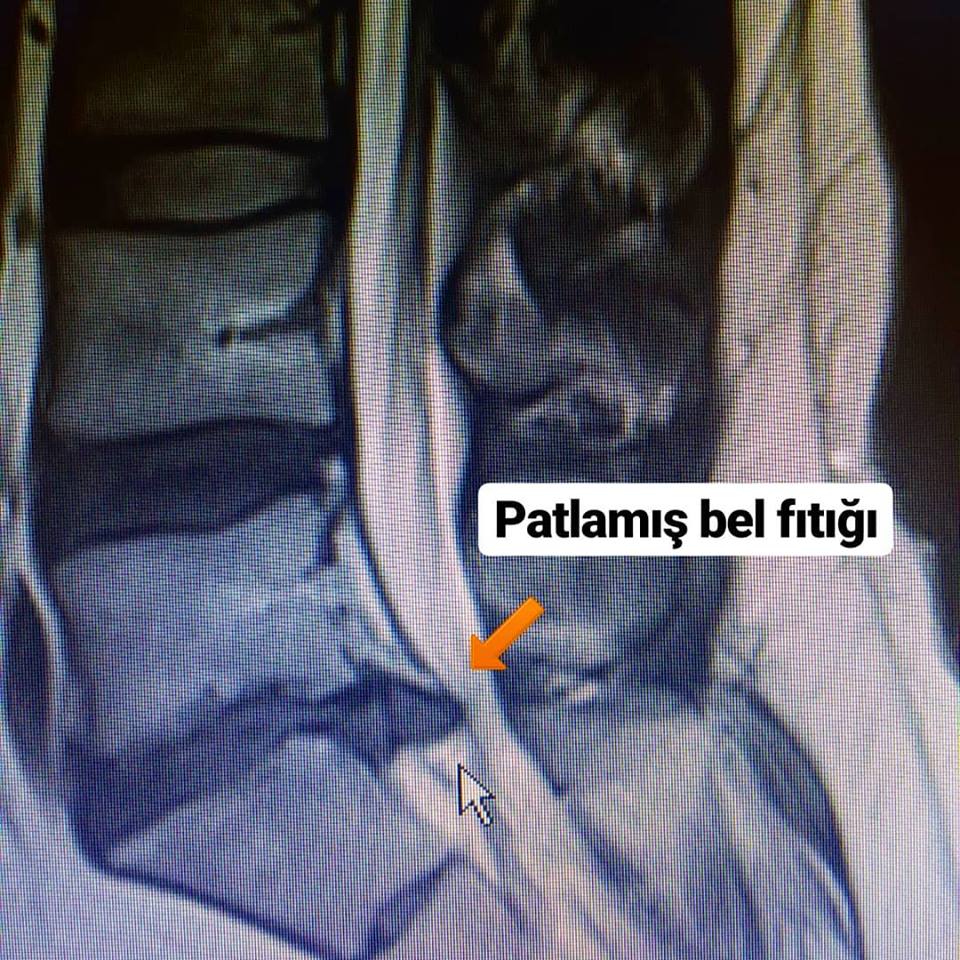 Bel fıtığım patlamış