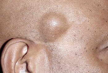 Saçlı Deri Lipom ve Kistlerinde Cerrahi Tedavi