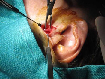 Temporal Arterit Hastalığında Biyopsi